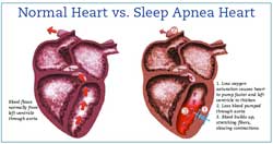 Heart & Sleep Apnea